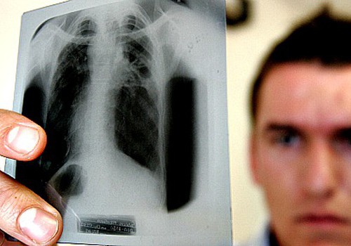В Риге стремительно распространяется туберкулез