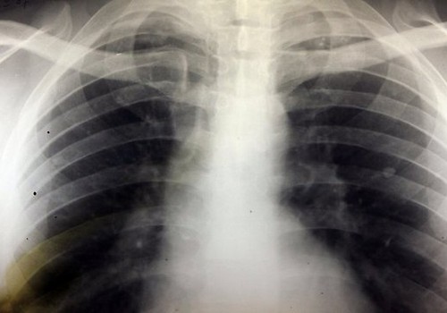 Рижан приглашают на бесплатный рентген легких