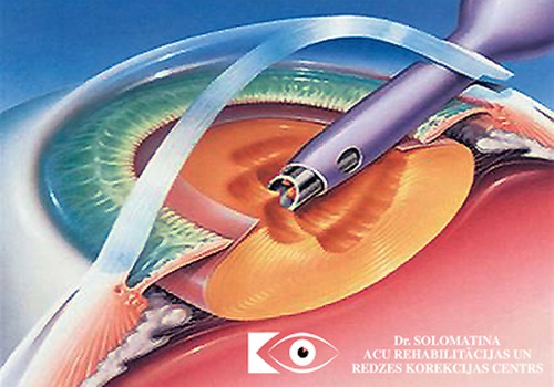 Что нужно знать об операции по удалению катаракты?