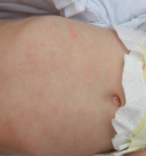Атопический дерматит, потница или аллергия?